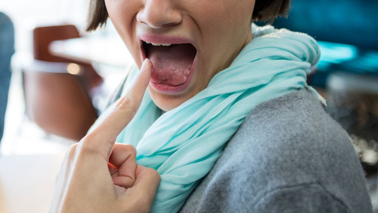 ગ્લિસરિન ત્વચા અને મોઢાના ચાંદા માટે ઉપયોગી માનવામાં આવે છે. જો જીભ બળી જાય, તો ગ્લિસરિન લગાવવાથી થોડી જ વારમાં રાહત મળે છે. દિવસમાં ત્રણથી ચાર વાર તેનો ઉપયોગ કરવાથી બળતરા અને અસ્વસ્થતા ઓછું થાય છે. (નોંધ : અહીં આપવામાં આવેલી માહિતી ફક્ત આપની જાણકારી માટે છે. કોઈ પણ રોકાણ કરવા પહેલા નિષ્ણાંતોની સલાહ લેવી જરૂરી છે.)