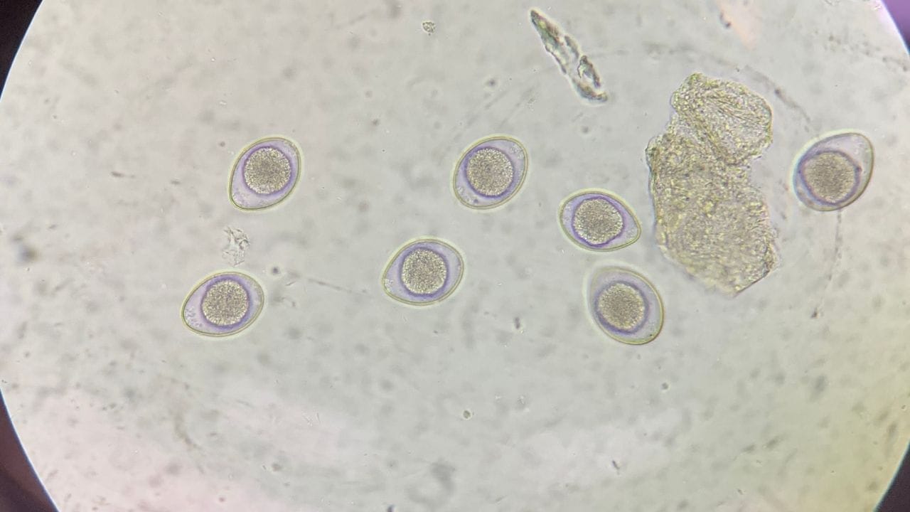 આજની દોડધામ ભરેલી જીવનશૈલીમાં ઘણી આદતો પુરુષોના સ્વાસ્થ્ય પર ઊંડી અસર કરી રહી છે, જેના કારણે શુક્રાણુઓની ગુણવત્તા પર સીધી અસર પડે છે. પુરુષોના પ્રજનન સ્વાસ્થ્ય માટે શુક્રાણુઓની સારી ગુણવત્તા ખૂબ જ મહત્વપૂર્ણ છે. સારી ગુણવત્તાનો અર્થ છે પૂરતી સંખ્યા, યોગ્ય આકાર અને સારી ગતિ, જે ગર્ભધારણની શક્યતા વધારે છે. શુક્રાણુઓની ઓછી સંખ્યા અથવા નબળી ગુણવત્તા ગર્ભધારણમાં અડચણ ઊભી કરી શકે છે. ઉપરાંત, નબળી ગુણવત્તા હોર્મોનલ અસંતુલન, થાક અને માનસિક તણાવનું સંકેત પણ હોઈ શકે છે.