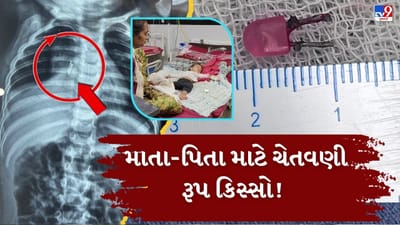 Breaking News : માતા-પિતા સાવધાન ! એક વર્ષના બાળકની શ્વાસનળીમાં ફસાયો LED બલ્બ, તબીબોએ VIDEO બ્રોન્કોસ્કોપી કરી બહાર કાઢ્યો Breaking News : માતા-પિતા સાવધાન ! એક વર્ષના બાળકની શ્વાસનળીમાં ફસાયો LED બલ્બ, તબીબોએ VIDEO બ્રોન્કોસ્કોપી કરી બહાર કાઢ્યો