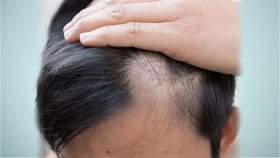 યુવાન પુરુષોમાં કેમ વધી રહ્યું છે ટાલિયાપણું? જાણો કારણો અને ઉપાયો