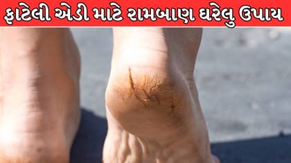 ફાટેલી એડીઓથી પરેશાન છો, આ 5 ઘરેલુ ઉપાય આવી શકે છે કામ !