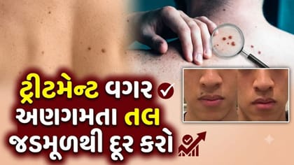 કેમિકલ કે મોંઘી ટ્રીટમેન્ટ વગર તલને જડમૂળથી કેવી રીતે હટાવવા?