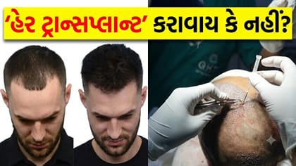 શું 'હેર ટ્રાન્સપ્લાન્ટ' સુરક્ષિત છે? જાણો તેના 'સાઇડ ઇફેક્ટ્સ'
